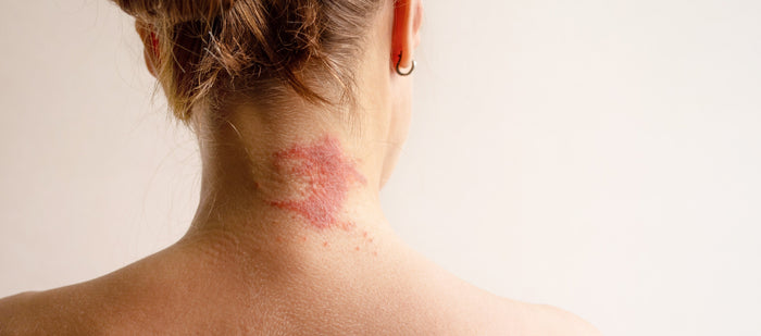 Eine junge Frau hat auf ihrem Nacken ein Eczema.